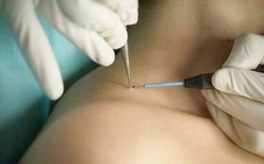 Papilloma elimination methods