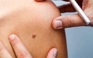 Papilloma treatment methods