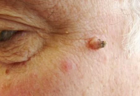 papilloma on the face
