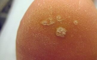 Why do plantar warts appear
