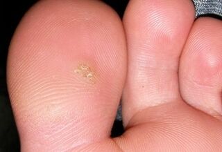 how to get rid of plantar wart