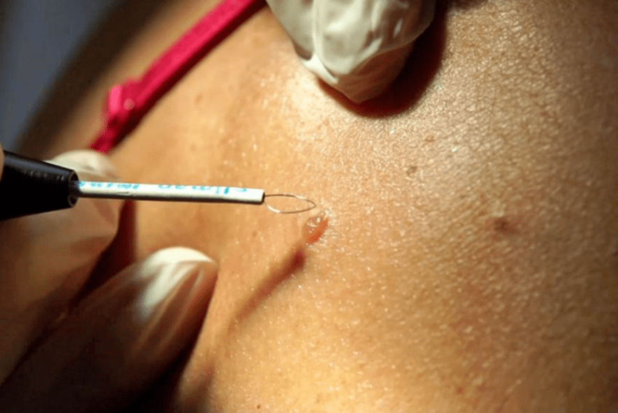 professional methods for removing papillomas