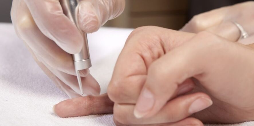 ways to remove papillomas on the hands and why they are dangerous