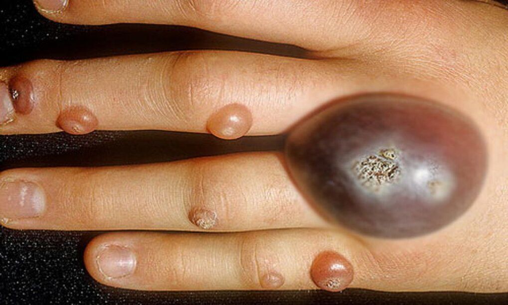 large warts on the hand