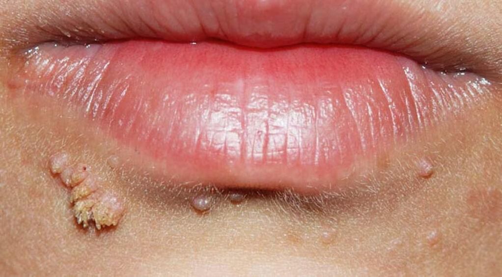 warts on lips