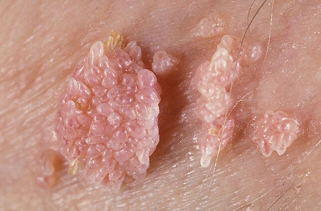 Papilloma is a benign tumor-like formation of the skin and mucous membranes, warty in nature. 
